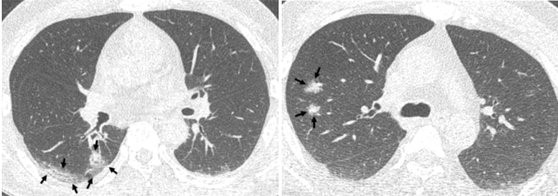 初期X光片中并无异常的患者在同一天拍摄的CT照片。来自尹顺镐等六人合著的《COVID-19影像医学分析：以9名韩国患者为例》，刊载于大韩影像医学会国际学术杂志《Korean Journal of Radiology》。【照片由KJR提供】