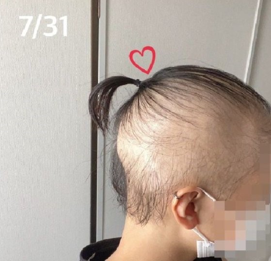 爆料自己接种莫德纳疫苗后开始脱发的日本女性。【照片来源：个人博客】