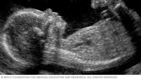 胎儿超声波图像示例，与文章无关。【照片来源：美国梅约医学教育研究基金会】