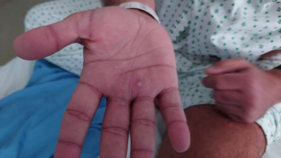 图为感染猴痘的患者手上出现的症状。【照片来源：路透社=韩联社】